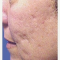 45-54 year old woman treated with Fraxel Laser before 1967400