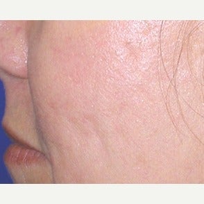 45-54 year old woman treated with Fraxel Laser after 1967400