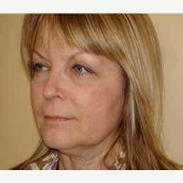 55-64 year old woman treated with Mini Lift and Upper Lid Blepharoplasty before 3264895