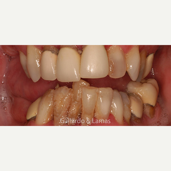 55-64 year old woman treated with All-on-4 Dental Implants before 3265885