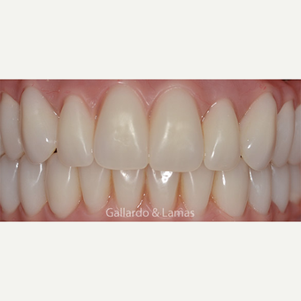55-64 year old woman treated with All-on-4 Dental Implants after 3265885