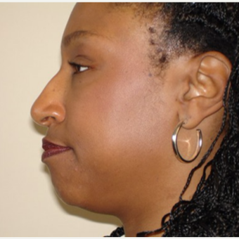 35-44 year old woman treated with Rhinoplasty before 3506667