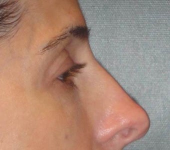 Restylane 967065