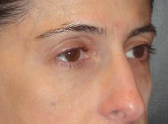Restylane after 967065