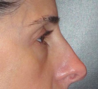 Restylane 967065