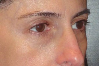 Restylane before 967065
