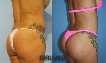 Lipoimplant combination Brazilian butt lift 1488402