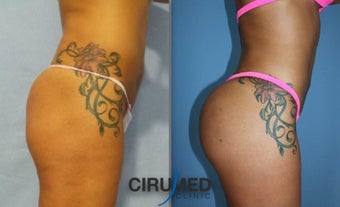 Lipoimplant combination Brazilian butt lift 1488402