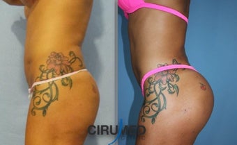 Lipoimplant combination Brazilian butt lift before 1488402