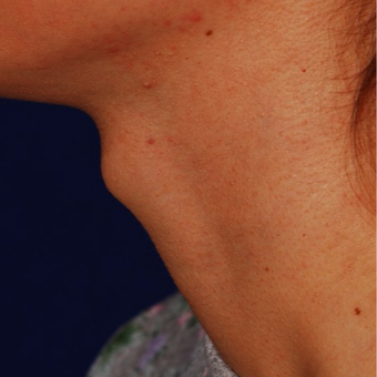 18-24 year old woman treated with Adam's Apple Reduction before 3624530
