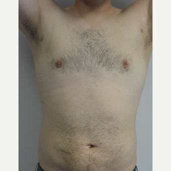 25-34 year old man treated with Male Breast Reduction after 3175410