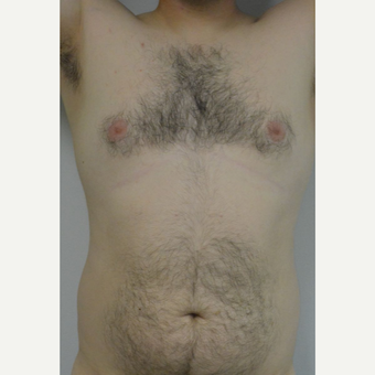 25-34 year old man treated with Male Breast Reduction before 3175410