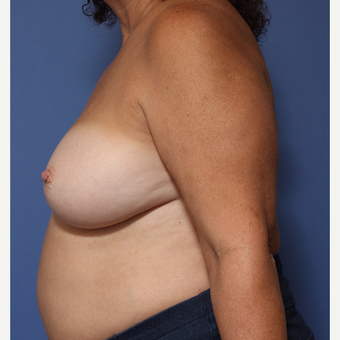 55-64 year old woman treated with Breast Implant Revision after 3782868