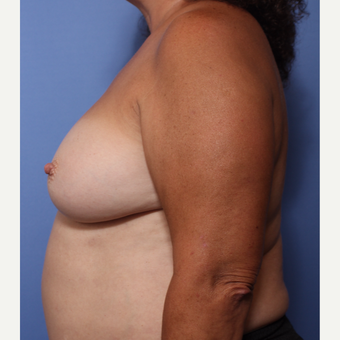 55-64 year old woman treated with Breast Implant Revision before 3782868