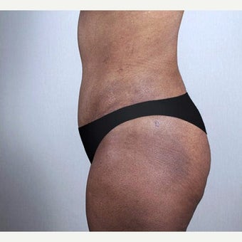 25-34 year old woman treated with Tummy Tuck 1910799