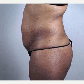 25-34 year old woman treated with Tummy Tuck 1910799