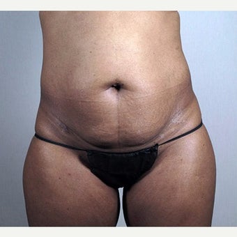 25-34 year old woman treated with Tummy Tuck before 1910799