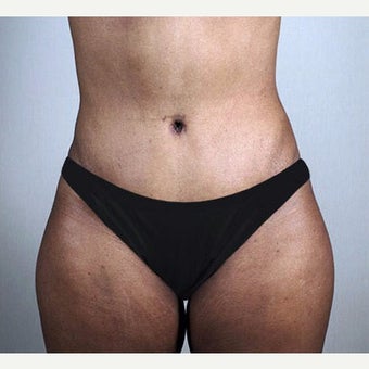25-34 year old woman treated with Tummy Tuck after 1910799