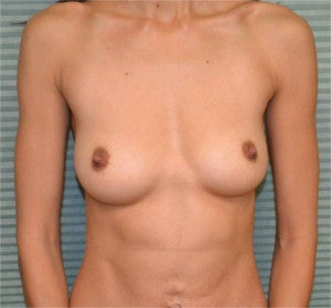 35 year old female breast augmentation before 1342405