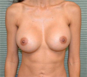 35 year old female breast augmentation after 1342405