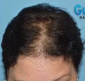 45-54 year old woman treated with Hair Loss Treatment before 3623623