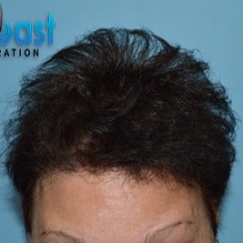 45-54 year old woman treated with Hair Loss Treatment after 3623623