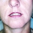 36 year old female patient before 928597