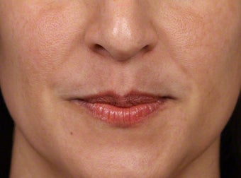 Brightening Facials for Melasma after 539894
