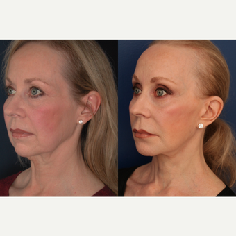 55-64 year old woman treated with Facelift after 3705777