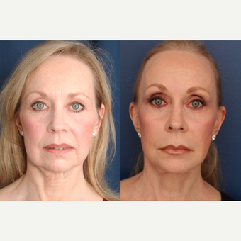 55-64 year old woman treated with Facelift before 3705777