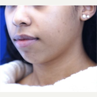 25-34 year old woman treated with Chin Implant before 3719121