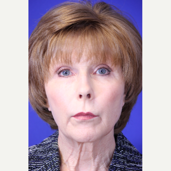 59 year old woman treated with Lower face and neck lift before 3419615
