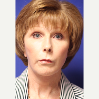 59 year old woman treated with Lower face and neck lift after 3419615