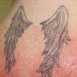 25-34 year old woman treated with Tattoo Removal before 3122542