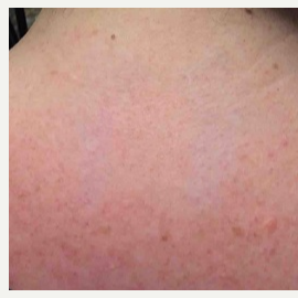 25-34 year old woman treated with Tattoo Removal after 3122542