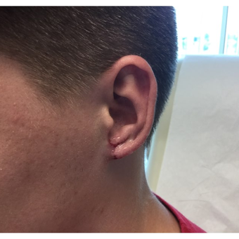18-24 year old man treated with Ear Lobe Surgery after 3245277