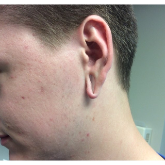 18-24 year old man treated with Ear Lobe Surgery before 3245277