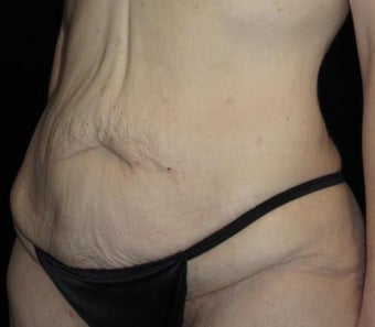 41 year old woman treated with Tummy Tuck 3092771