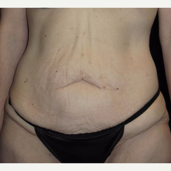41 year old woman treated with Tummy Tuck before 3092771
