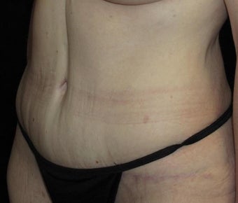41 year old woman treated with Tummy Tuck 3092771