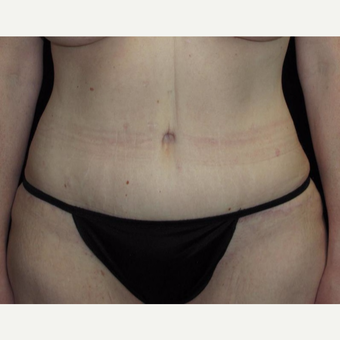 41 year old woman treated with Tummy Tuck after 3092771