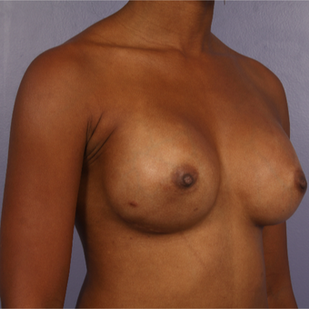 25-34 year old woman treated with Breast Augmentation after 3226373