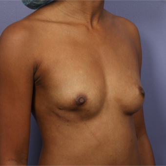 25-34 year old woman treated with Breast Augmentation before 3226373