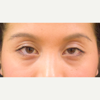 25-34 year old woman treated with Asian Eyelid Surgery before 3305028
