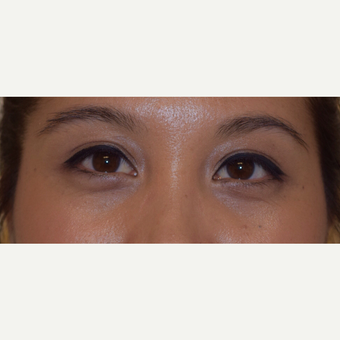 25-34 year old woman treated with Asian Eyelid Surgery after 3305028