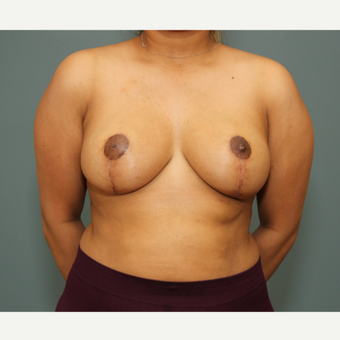 25-34 year old woman treated with Breast Reduction after 3245757