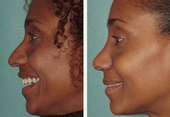 Attractive African American actress in her mid-thirties who felt her nose was larger than her other features after 659596
