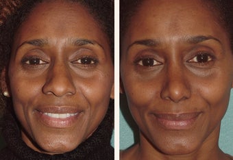 Attractive African American actress in her mid-thirties who felt her nose was larger than her other features before 659596