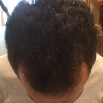 25-34 year old man treated with PRP for Hair Loss Low Laser Light Therapy after 2036302