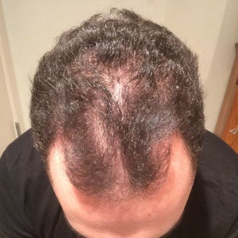 25-34 year old man treated with PRP for Hair Loss Low Laser Light Therapy before 2036302